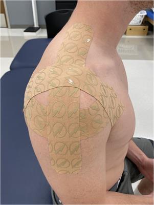 Evaluating the effects of two different kinesiology taping techniques on shoulder pain and function in patients with hypermobile Ehlers-Danlos syndrome